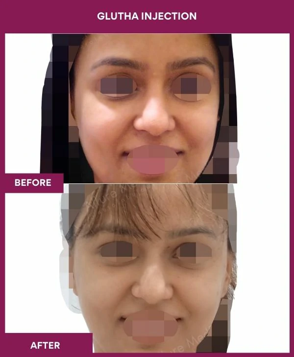 glutathione-injection-before-after-results-mumbai-india-patient05-face