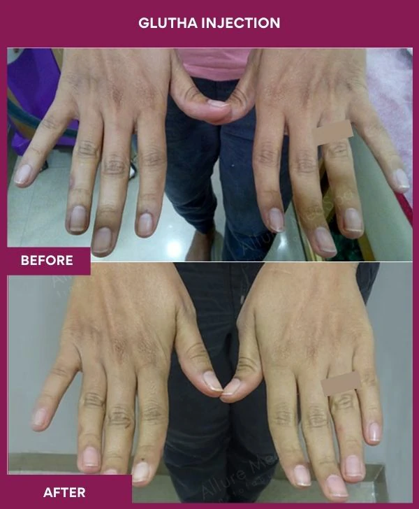 glutathione-injection-before-after-results-mumbai-india-patient05-hand