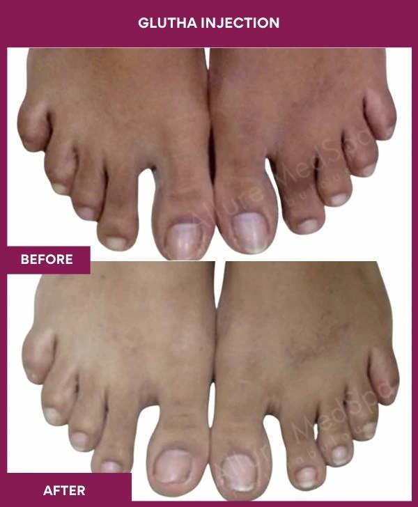glutathione-injection-before-after-results-mumbai-india-patient05-leg