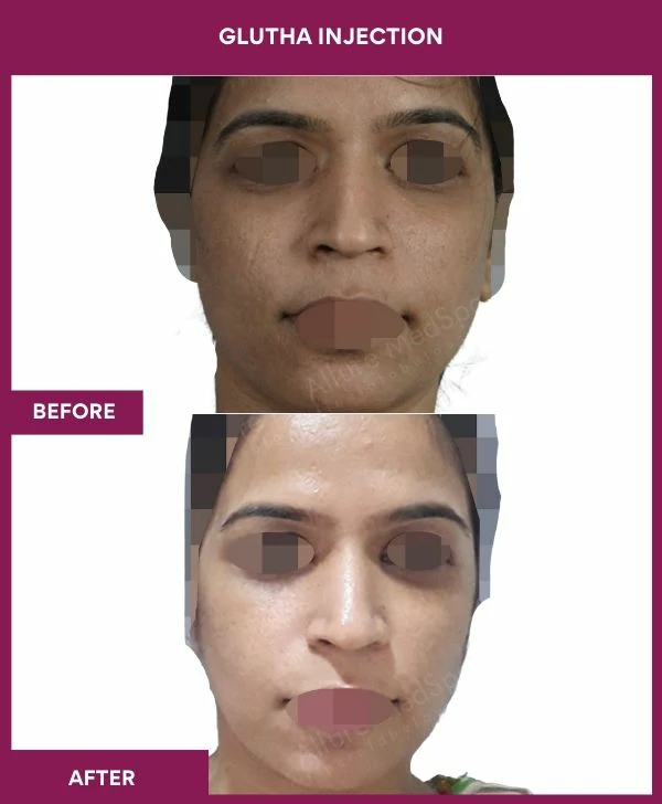 glutathione-injection-before-after-results-mumbai-india-patient06-face
