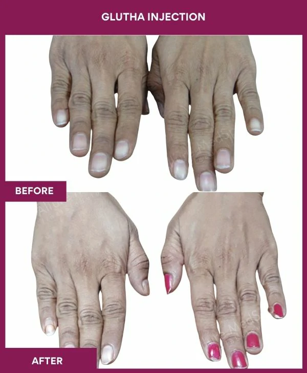 glutathione-injection-before-after-results-mumbai-india-patient06-hand