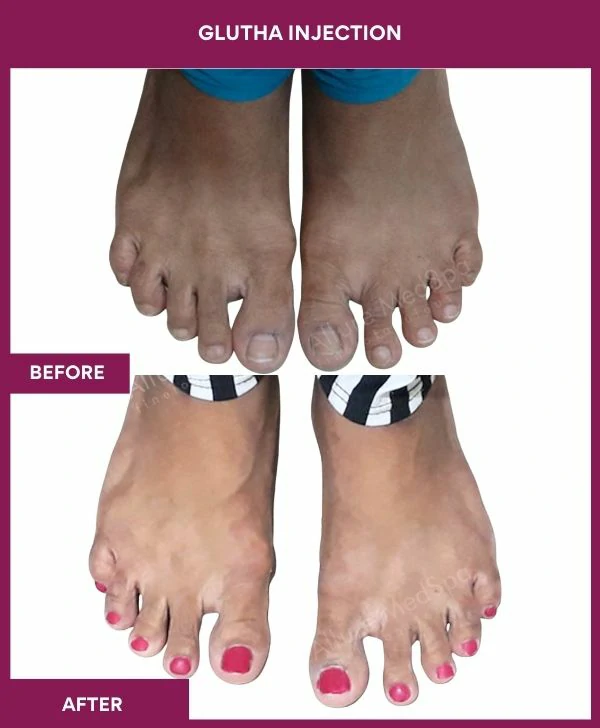glutathione-injection-before-after-results-mumbai-india-patient06-leg