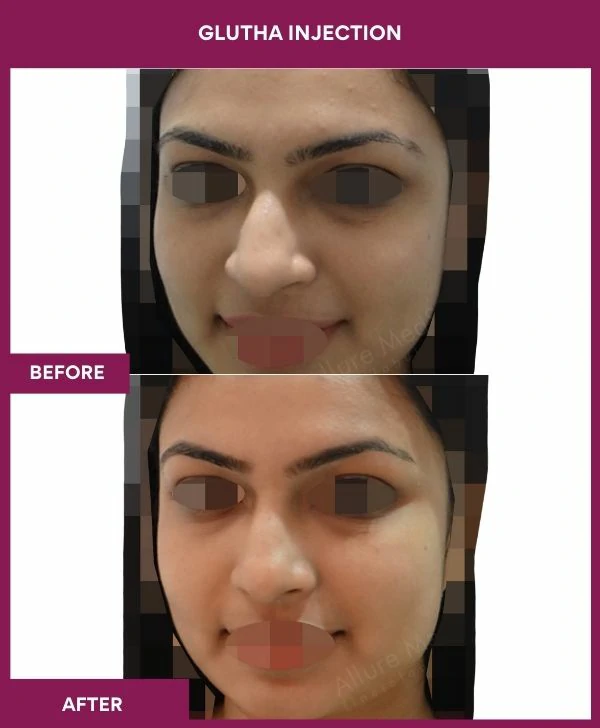 glutathione-injection-before-after-results-mumbai-india-patient07-face
