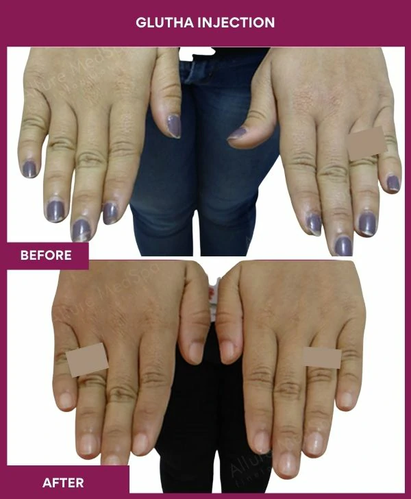 glutathione-injection-before-after-results-mumbai-india-patient07-hand