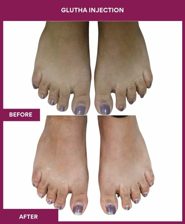 glutathione-injection-before-after-results-mumbai-india-patient07-leg