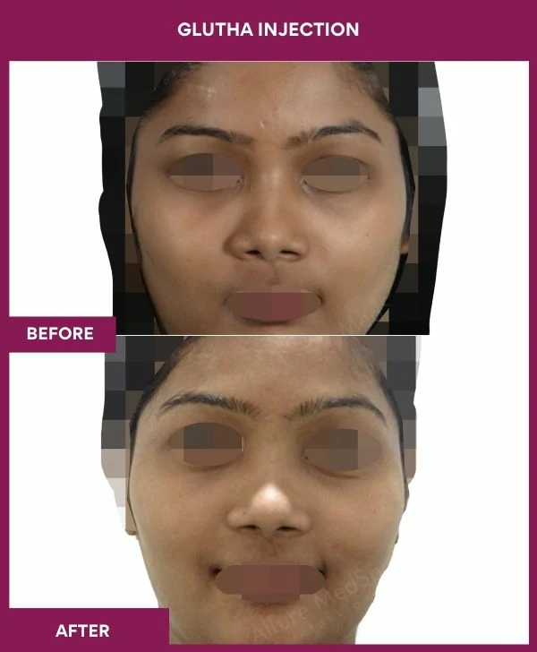glutathione-injection-before-after-results-mumbai-india-patient08-face
