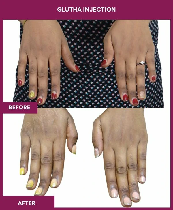 glutathione-injection-before-after-results-mumbai-india-patient08-hand