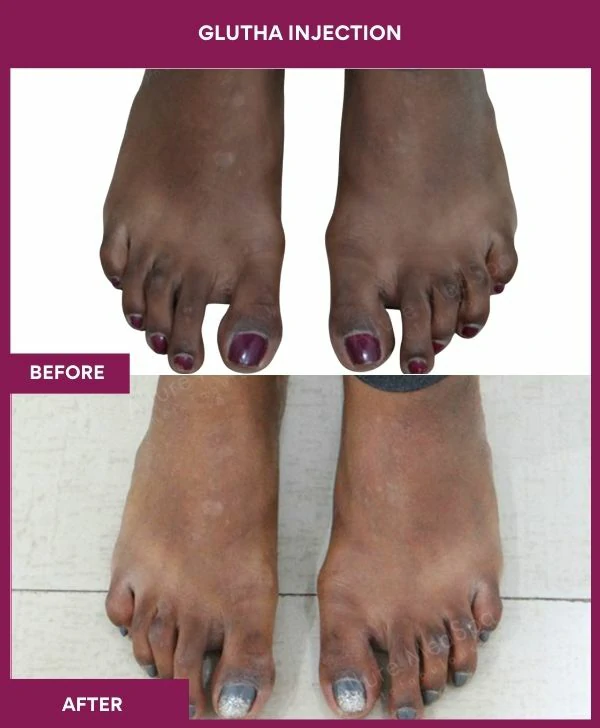 glutathione-injection-before-after-results-mumbai--india-patient08-leg