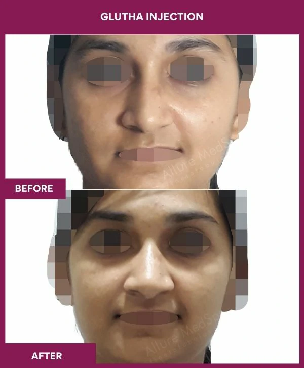 glutathione-injection-before-after-results-mumbai-india-patient09-face
