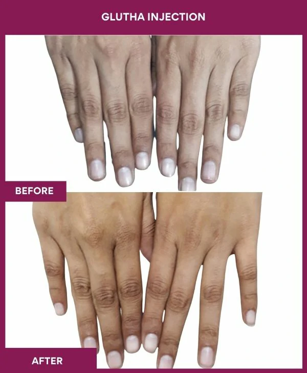 glutathione-injection-before-after-results-mumbai-india-patient09-hand