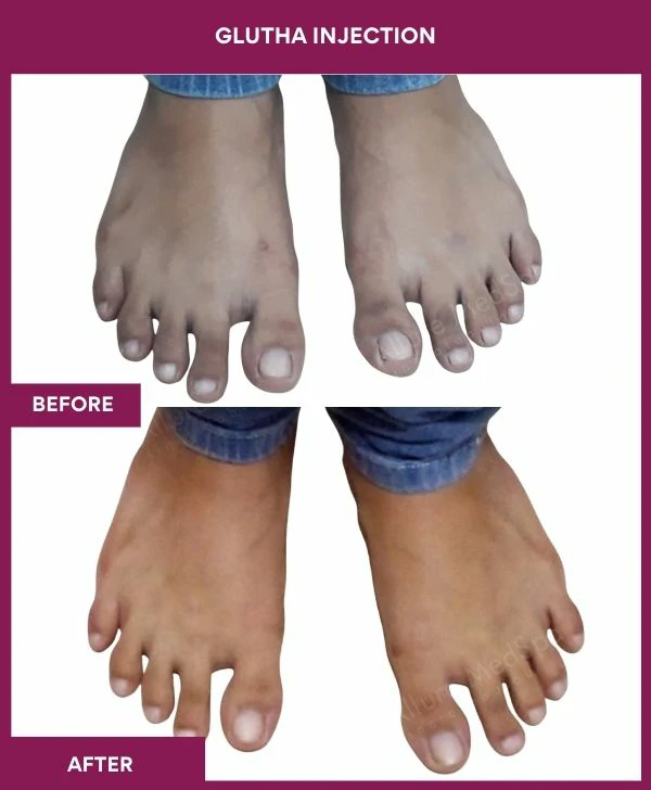 glutathione-injection-before-after-results-mumbai-india-patient09-leg