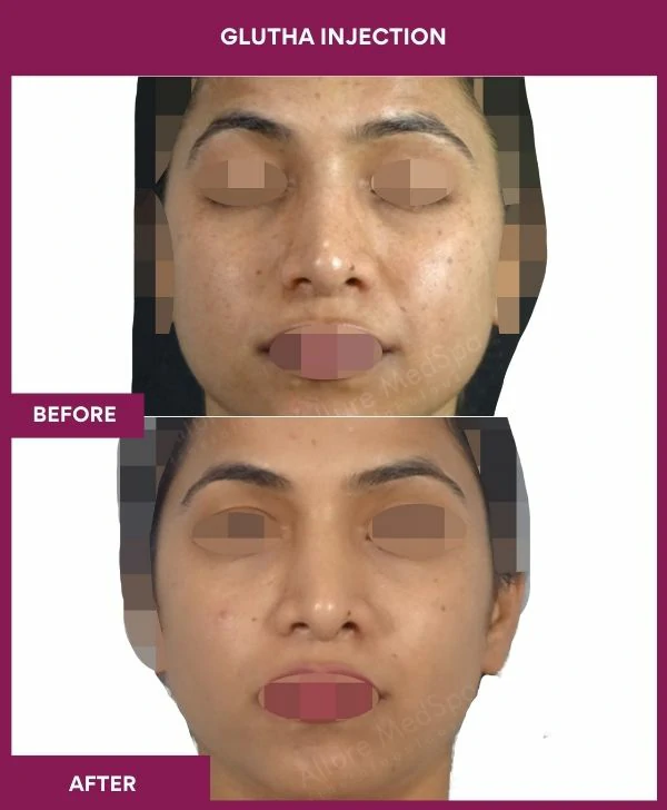 glutathione-injection-before-after-results-mumbai-india-patient10-face
