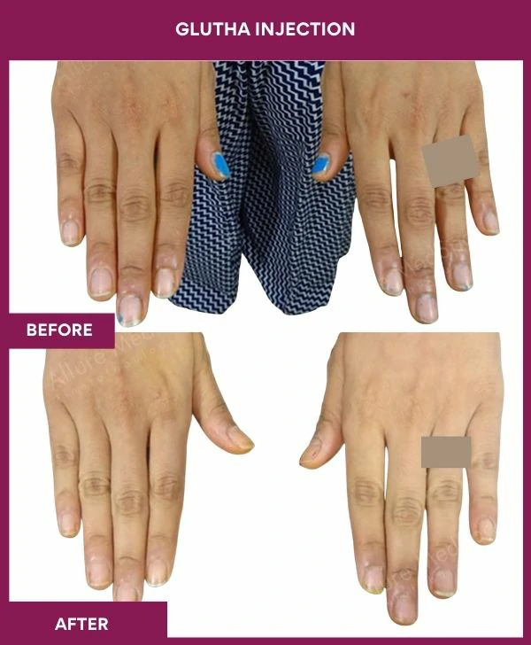 glutathione-injection-before-after-results-mumbai-india-patient10-hand