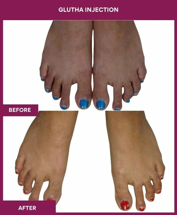 glutathione-injection-before-after-results-mumbai-india-patient10-leg