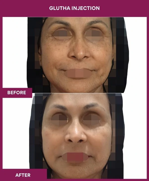 glutathione-injection-before-after-results-mumbai-india-patient11-face