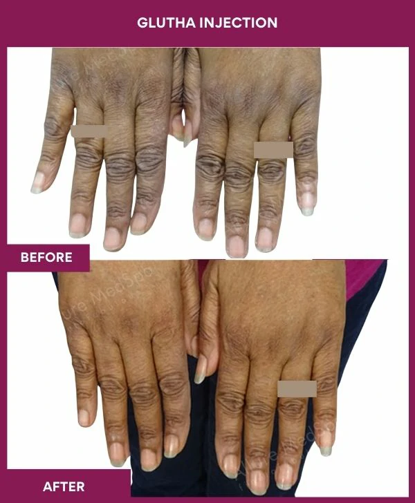 glutathione-injection-before-after-results-mumbai-india-patient11-hand