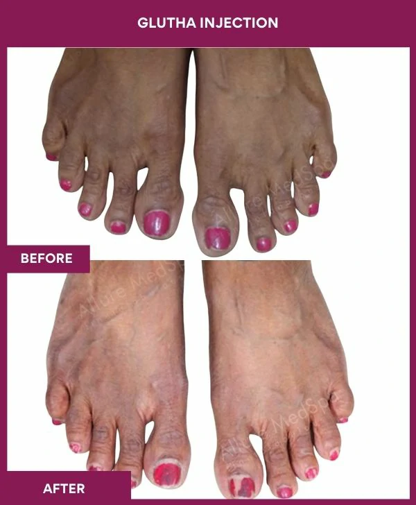 glutathione-injection-before-after-results-mumbai-india-patient11-leg