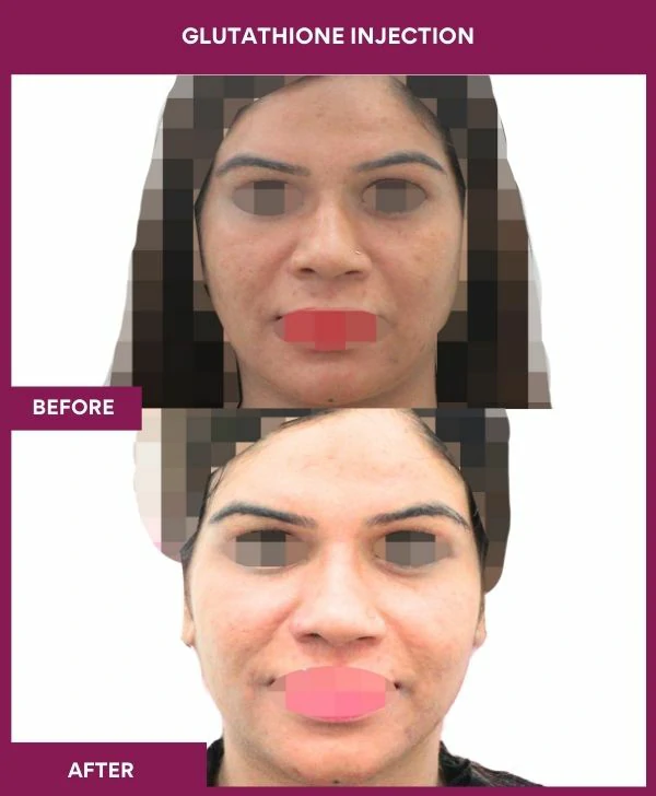 glutathione-injection-before-after-results-mumbai-india-patient12-face