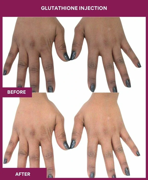glutathione-injection-before-after-results-mumbai-india-patient12-hand