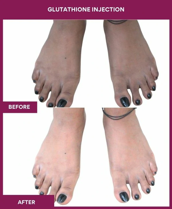 glutathione-injection-before-after-results-mumbai-india-patient12-leg