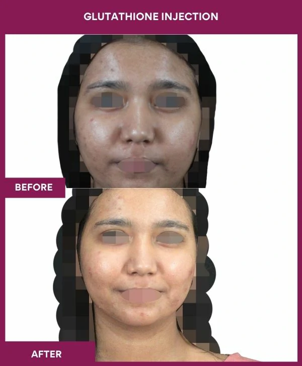glutathione-injection-before-after-results-mumbai-india-patient13-face