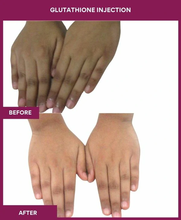 glutathione-injection-before-after-results-mumbai-india-patient13-hand