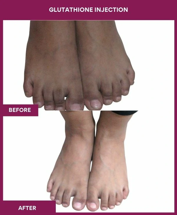 glutathione-injection-before-after-results-mumbai-india-patient13-leg