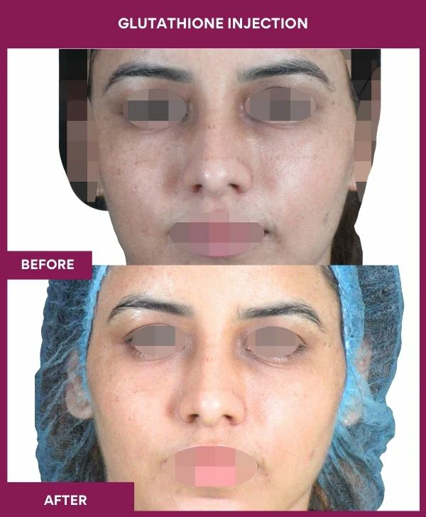 glutathione-injection-before-after-results-mumbai-india-patient14-face