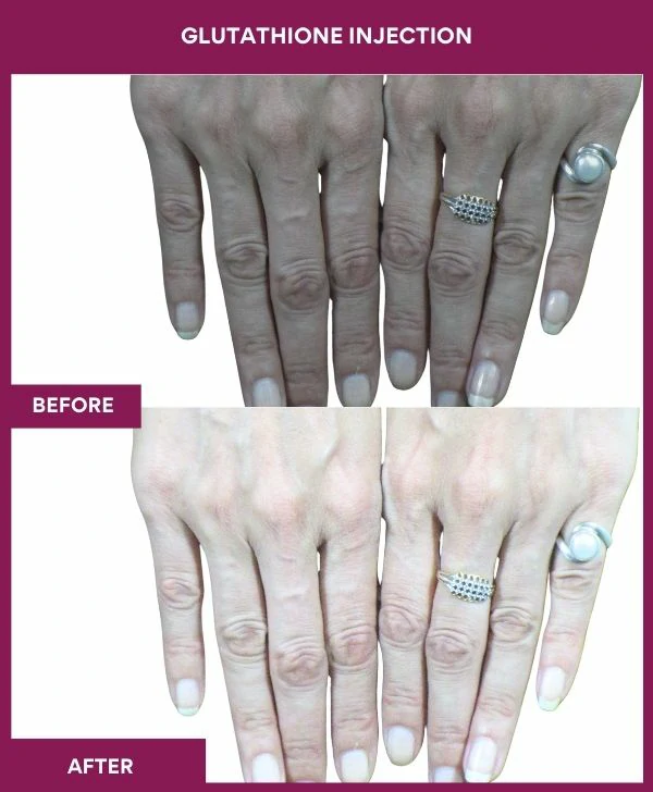 glutathione-injection-before-after-results-mumbai-india-patient14-hand