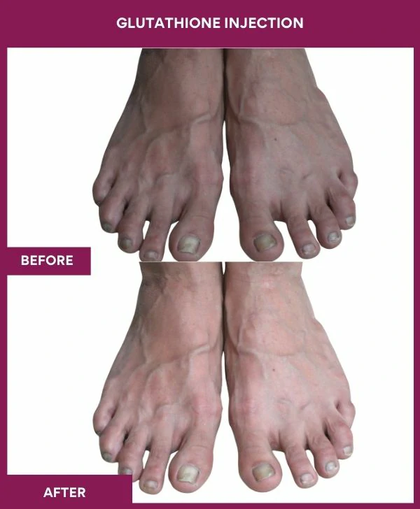 glutathione-injection-before-after-results-mumbai-india-patient14-leg