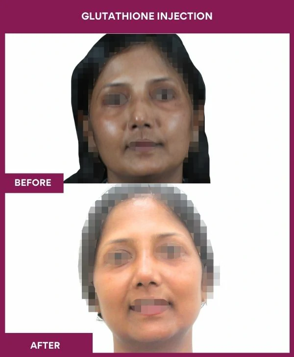 glutathione-injection-before-after-results-mumbai-india-patient15-face