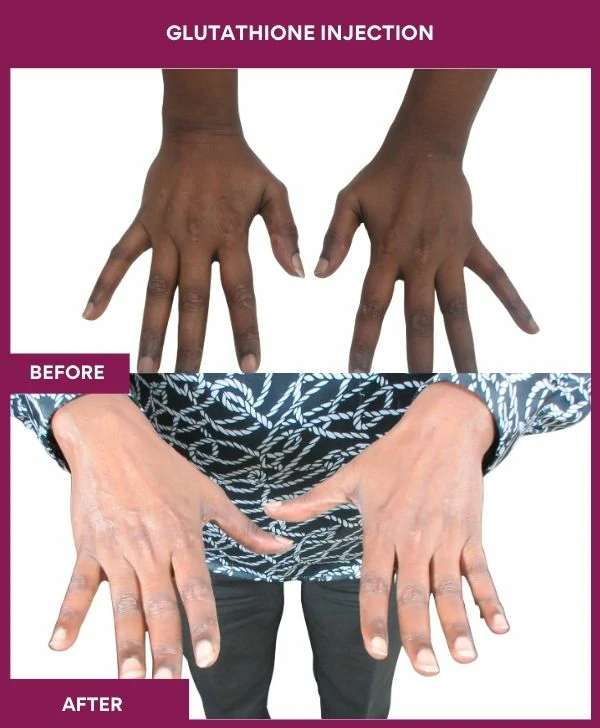glutathione-injection-before-after-results-mumbai-india-patient15-hand