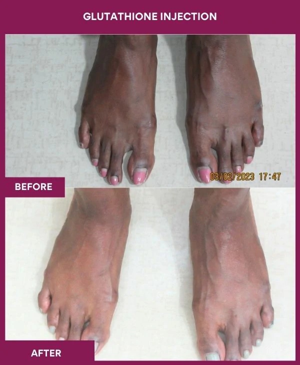 glutathione-injection-before-after-results-mumbai-india-patient15-leg