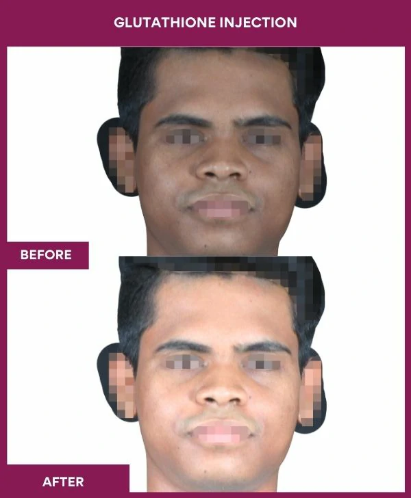 glutathione-injection-before-after-results-mumbai-india-patient16-face