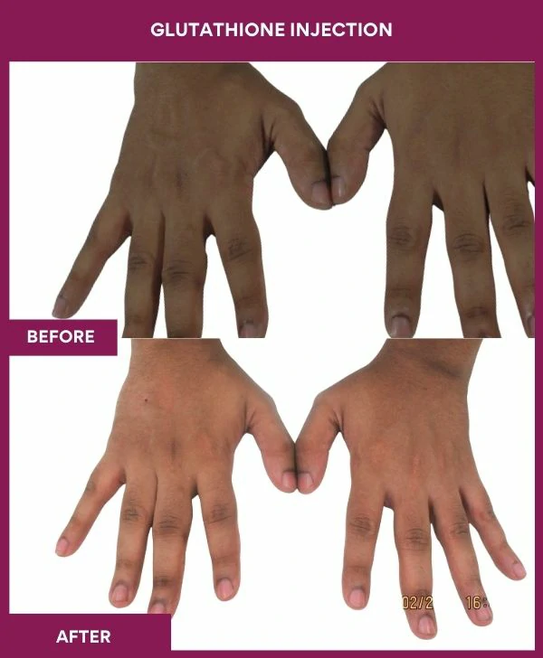 glutathione-injection-before-after-results-mumbai-india-patient16-hand