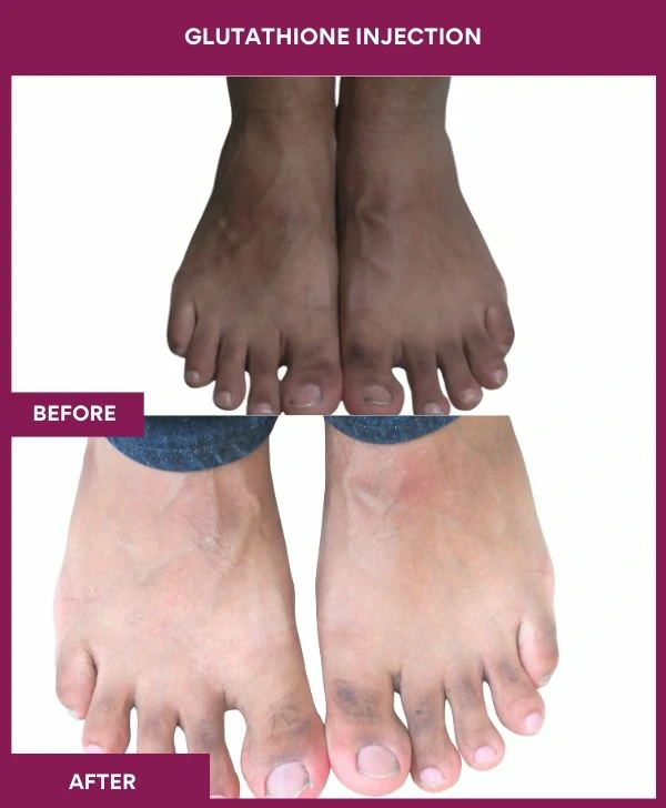 glutathione-injection-before-after-results-mumbai-india-patient16-leg