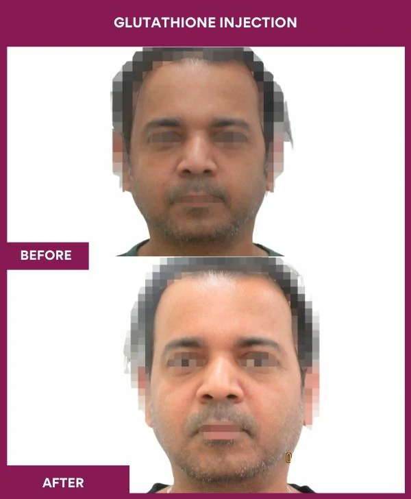 glutathione-injection-before-after-results-mumbai-india-patient17-face