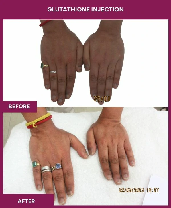 glutathione-injection-before-after-results-mumbai-india-patient17-hand