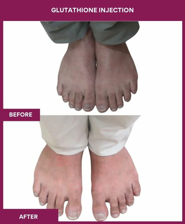 glutathione-injection-before-after-results-mumbai-india-patient17-leg