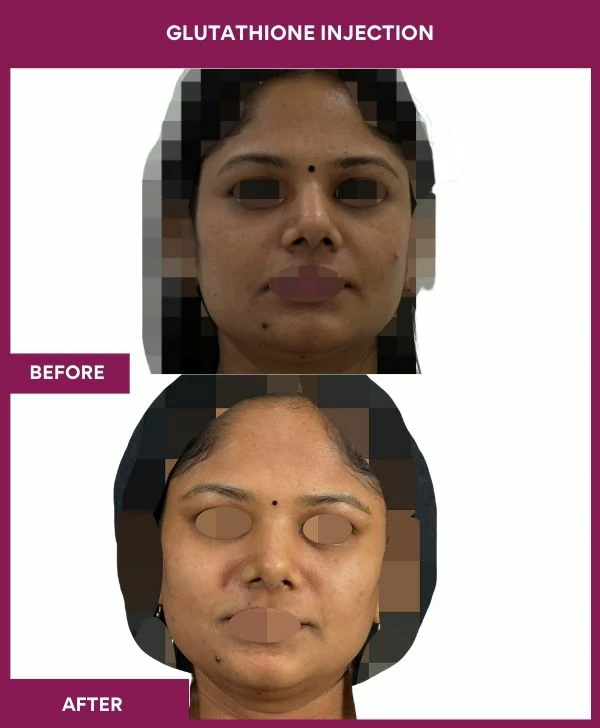 glutathione-injection-before-after-results-mumbai-india-patient18-face