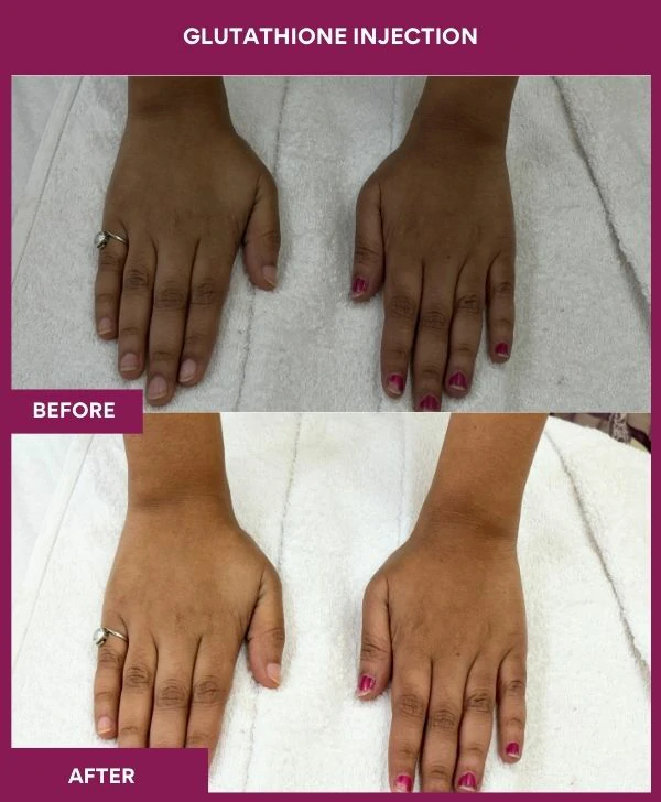 glutathione-injection-before-after-results-mumbai-india-patient18-hand