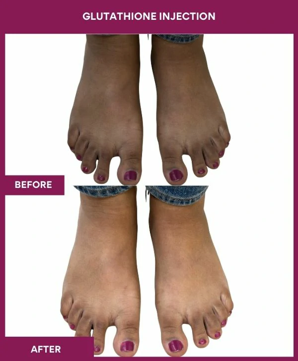 glutathione-injection-before-after-results-mumbai-india-patient18-leg