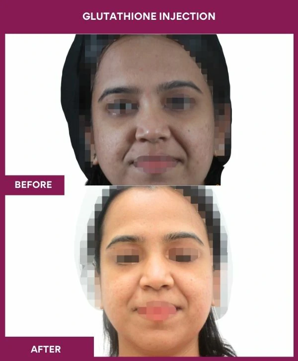 glutathione-injection-before-after-results-mumbai-india-patient19-face