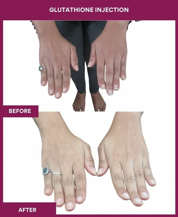 glutathione-injection-before-after-results-mumbai-india-patient19-hand