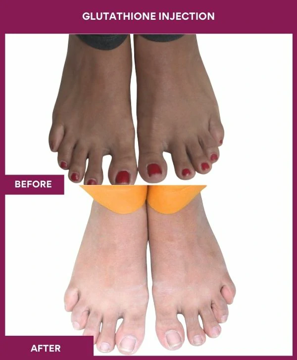 glutathione-injection-before-after-results-mumbai-india-patient19-leg