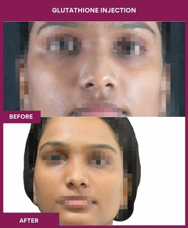 glutathione-injection-before-after-results-mumbai-india-patient20-face