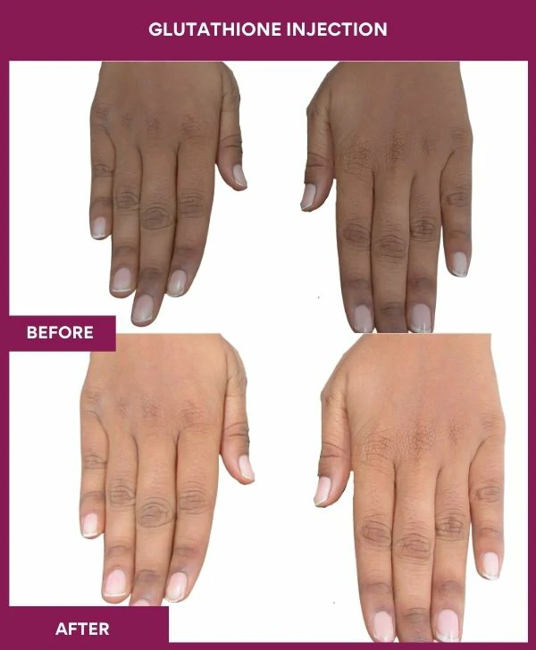 glutathione-injection-before-after-results-mumbai-india-patient20-hand