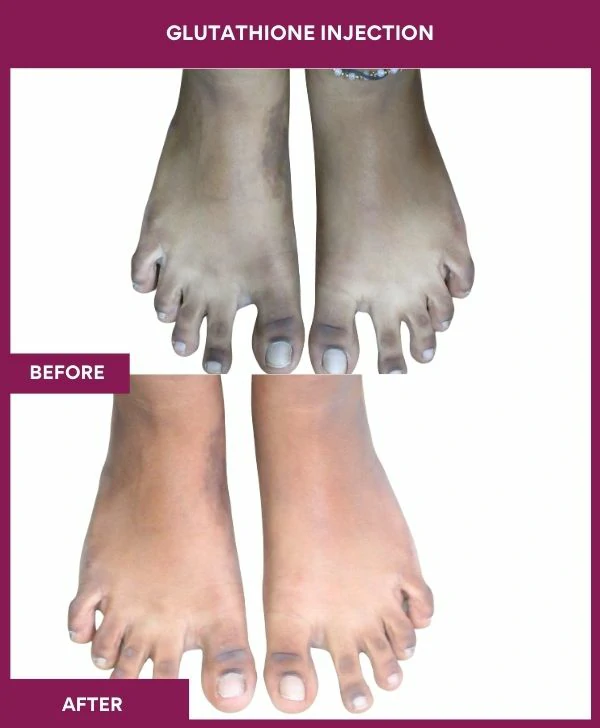 glutathione-injection-before-after-results-mumbai-india-patient20-leg