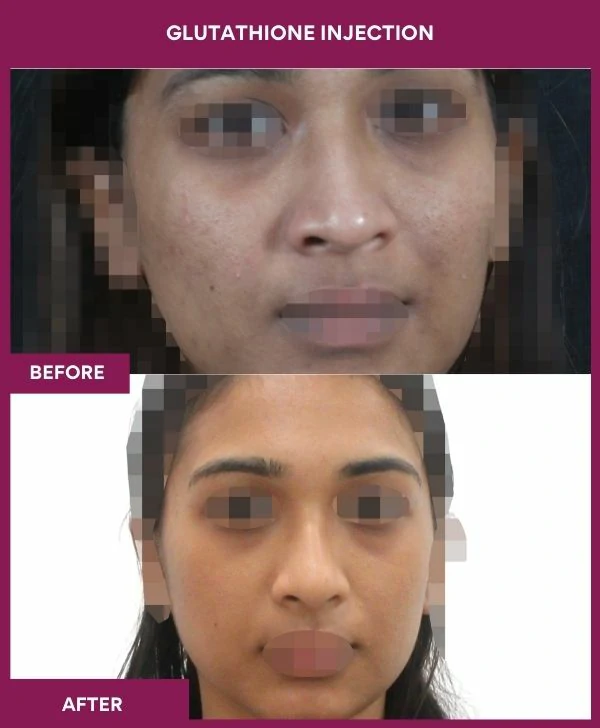 glutathione-injection-before-after-results-mumbai-india-patient21-face