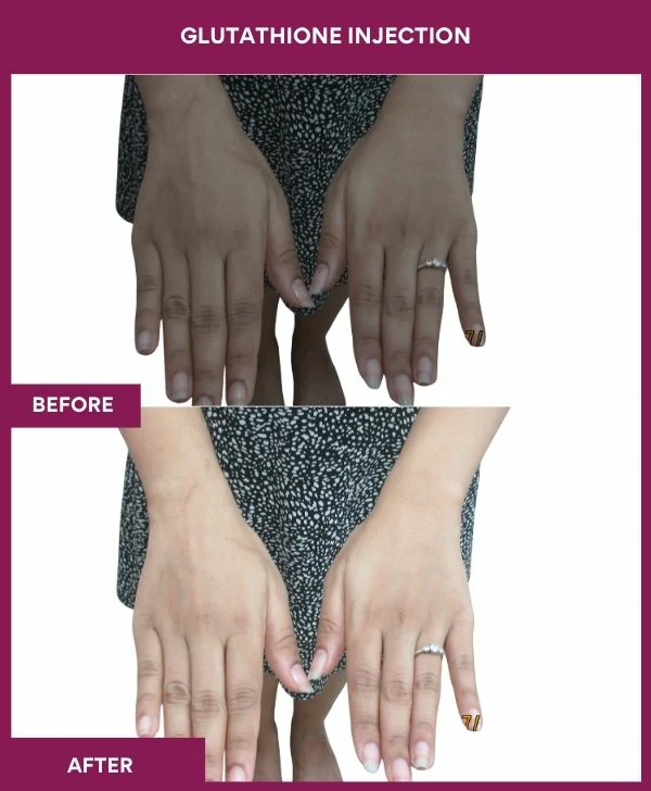 glutathione-injection-before-after-results-mumbai-india-patient21-hand